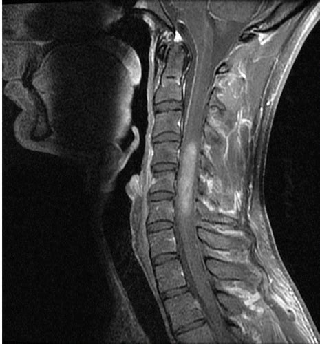 Cervical Spine Mri Tumor