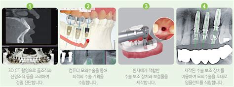 디지털임플란트