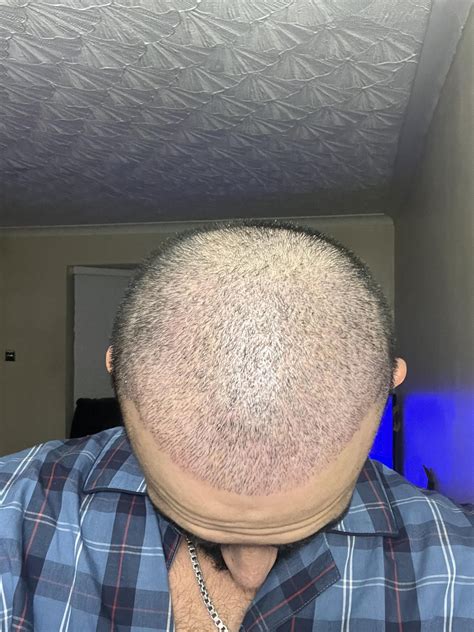 Day 11- I have removed all Scabs : r/Hairloss