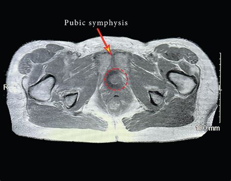 Mri Of The Pelvis Demonstrating An Undefined Structure In The Posterior