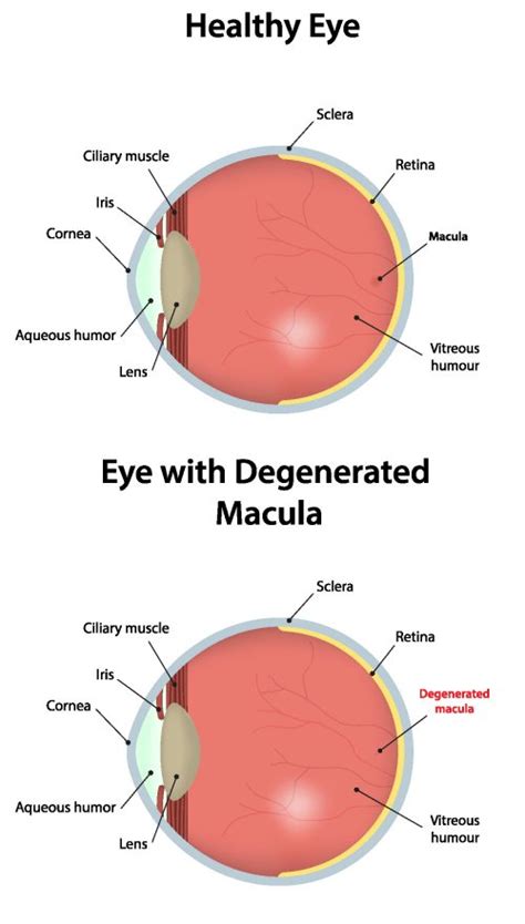 macular degeneration blindness dry eye central vision loss