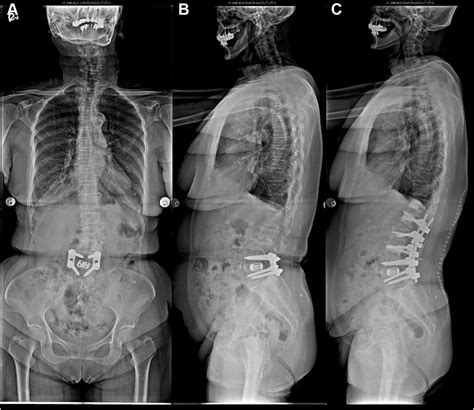 A And B Standing Radiographs Anteroposterior And Lateral View