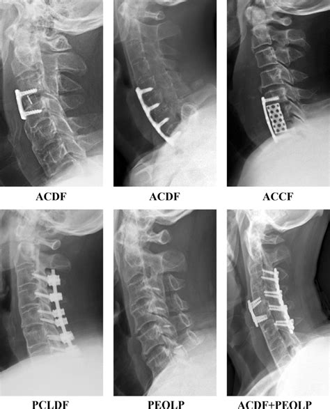 Typical Cases Of Different Surgical Methods Acdf Anterior Cervical