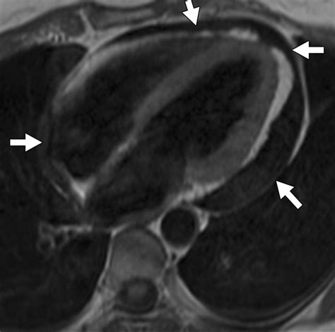 Constrictive Pericarditis Mri