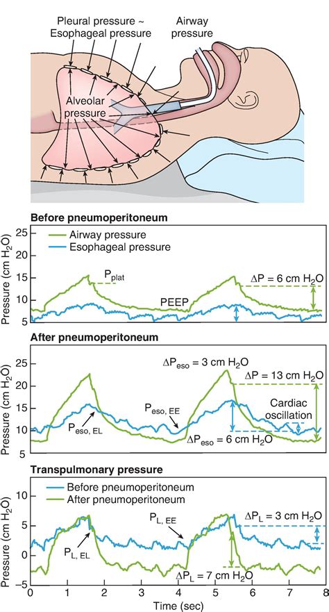 Pulmonary Pathophysiology And Lung Mechanics In Anesthesiology