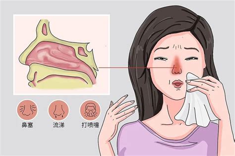 鼻炎難以根治可能跟這些有關 壹讀