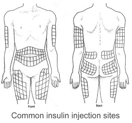 Insulin Injection Sites Pdf