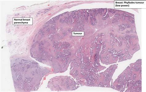 Breast Phyllodes Tumour Nus Pathweb Nus Pathweb