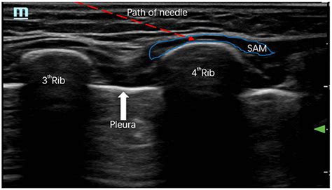 Paravertebral Block Ultrasound