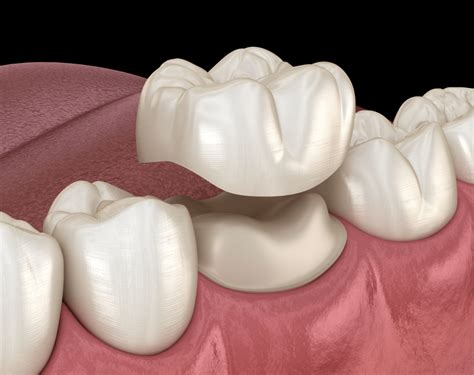 Should You Get Porcelain Crowns Tooth Crown Vida