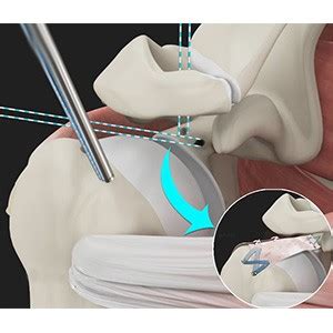 Arthroscopic Superior Capsular Reconstruction Indianapolis Reverse