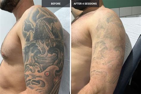 Transformations Unveiled Laser Tattoo Removal Before And After Laser