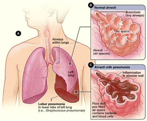 Pneumonia My Medical Handbook Wiki Fandom