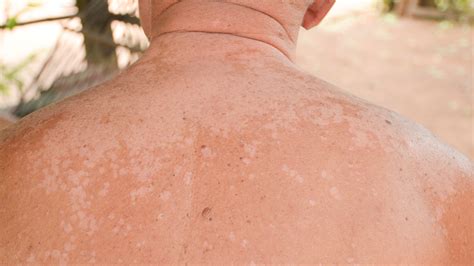 Pityriasis Versicolor Tout Savoir Sur Cette Mycose Cutan E