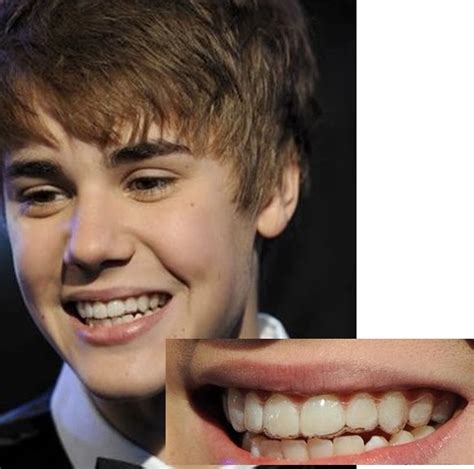 Celebrities Wearing Invisalign