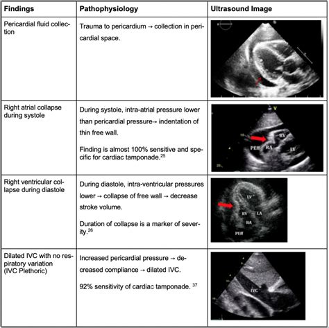 Pericardial Tamponade Ultrasound