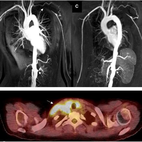 A Magnetic Resonance Angiogram Mra At Presentation Demonstrating An Download Scientific