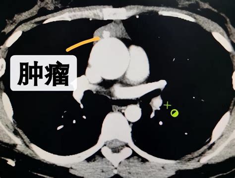 剑突下切口胸腔镜完整切除胸腺瘤，患者体表只有一个“钥匙孔”！ 腾讯新闻