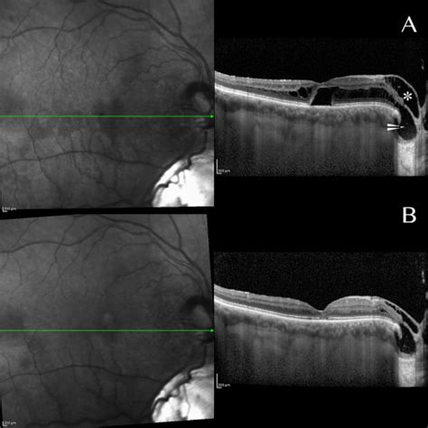 Spontaneous Resolution Of Optic Disc Pit Maculopathy After Posterior