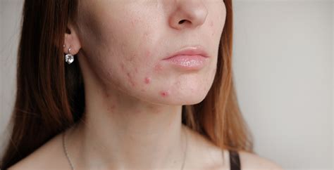 Acne Nodules On Face