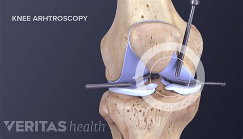 Types of Knee Surgery for Arthritis Treatment | Arthritis-health