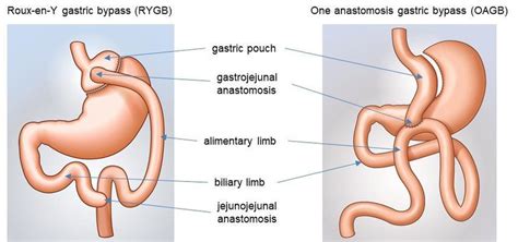 Illustration Of The Two Gastric Bypass Techniques Roux En Y And One