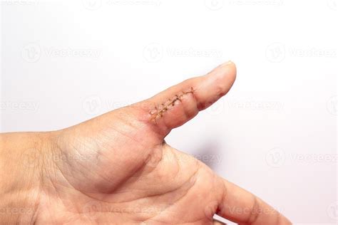 Close Up Of A Hand Wound With Stitches Thumb Wound On White Background