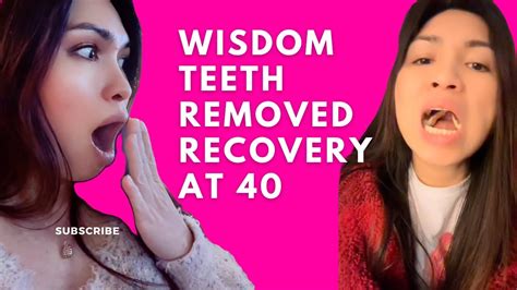 Impacted Wisdom Teeth Recovery After Surgery How I Avoid Swelling Face Youtube