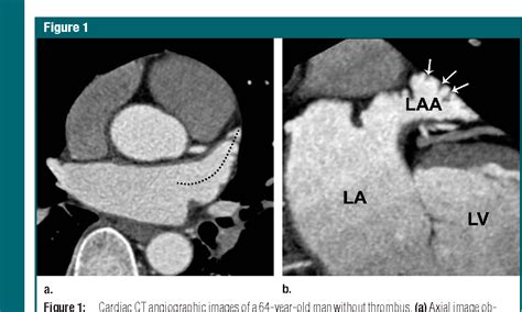 Left Atrial Thrombus Hot Sex Picture