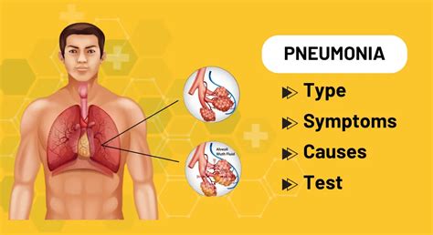 Pneumonia Symptoms What Are The Early Signs Of Pneumonia