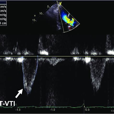 Representative Echocardiographic Findings Of Left Ventricular Outflow Download Scientific