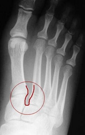 Lis Franc Fracture Tarsometatarsal Fracture Dislocation Flashcards