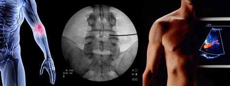 Radiofrequency Nerve Ablation | Inovo Medical