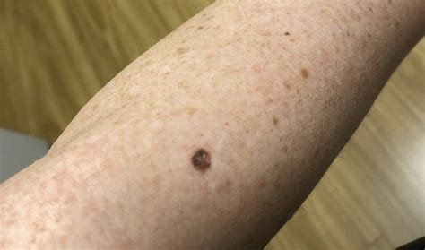 Early Malignant Melanoma In Situ