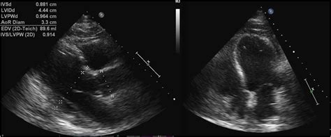 Figure 4 Transthoracic Echocardiogram Shows Normal Ejection Fraction