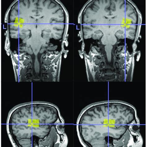 Example Temporal Lobe H Mrs Voxel Placement Example Participant Left