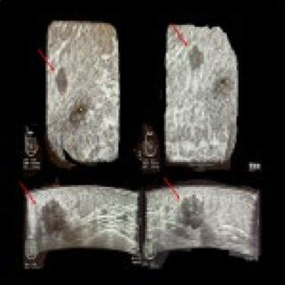 ABUS Images Of The Right Breast Of A 68 Year Old Patient Who Presented