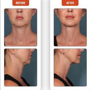 Kybella The New Fda Approved Injection For A Double Chin