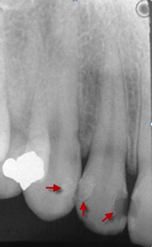 Radiographic Appearance Of Dental Tissues And Materials Exam 2