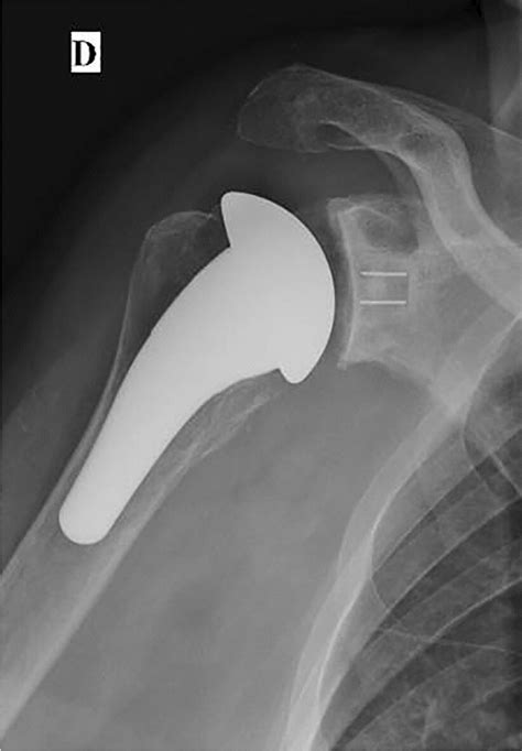 Antero Posterior Radiograph Of An Uncemented Anatomic Shoulder Download Scientific Diagram