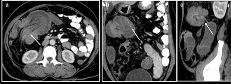 A Axial Contrast Ct Showing An Ileocolic Intussusception Arrow B