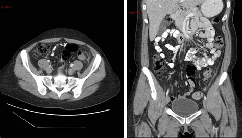 Epiploic Appendagitis