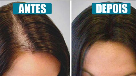 Como Parar A Perda De Cabelo Hair Loss Treatment Hair Loss Natural