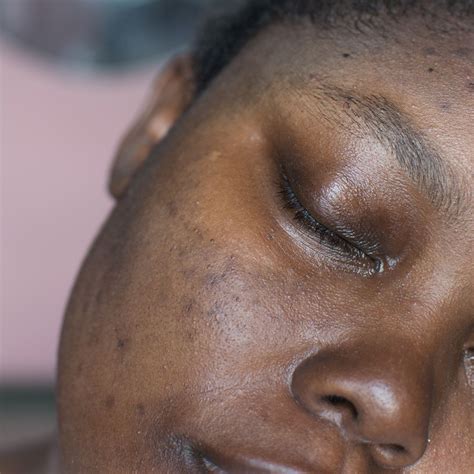 Pigmentation Treatment Beautified Skin Revision