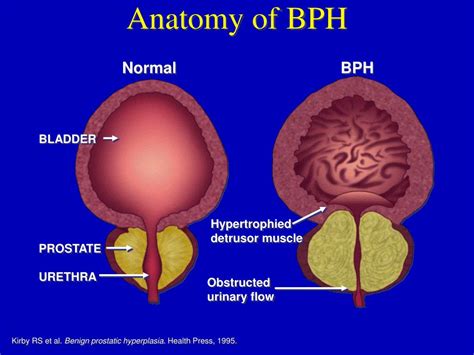 Benign Prostatic Hyperplasia Pathophysiology Diagram