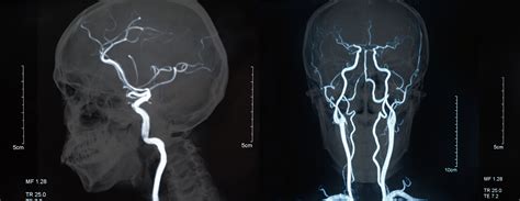 Magnetic resonance angiography