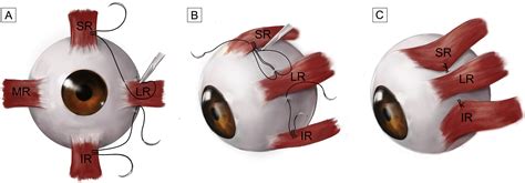 Outcomes Of Modified Vertical Rectus Belly Transposition Versus