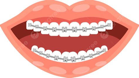 Smile With Braces Clipart