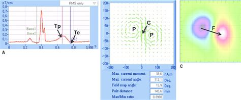 Measurement of MCG. (A) MCG tracing. (B) Current vector density map ...