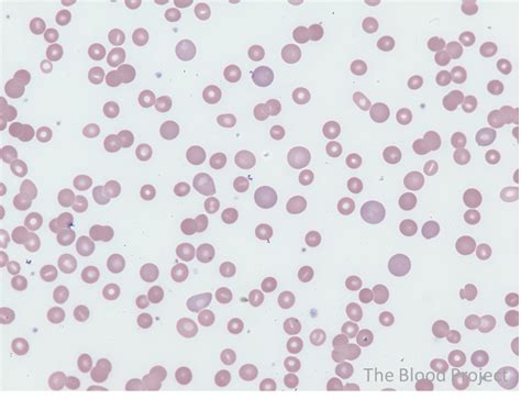 Warm Autoimmune Hemolytic Anemia • The Blood Project